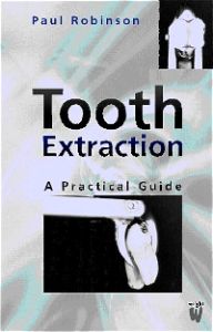 Tooth Extraction